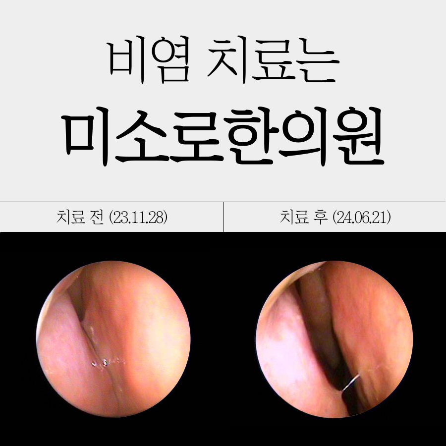 정자역 비염수술 병원비교 관련 이미지