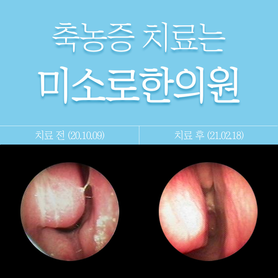 여주 축농증 내시경 수술비용 관련 이미지