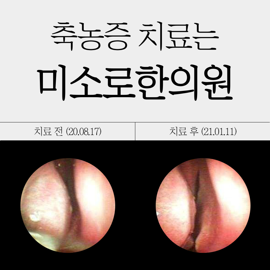 위례 부비동염 약 설사 관련 이미지
