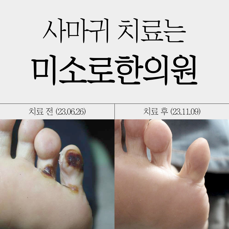 분당 발바닥 사마귀 병원 관련 이미지