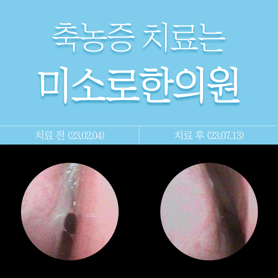 만성 축농증 치료 방법 관련 이미지