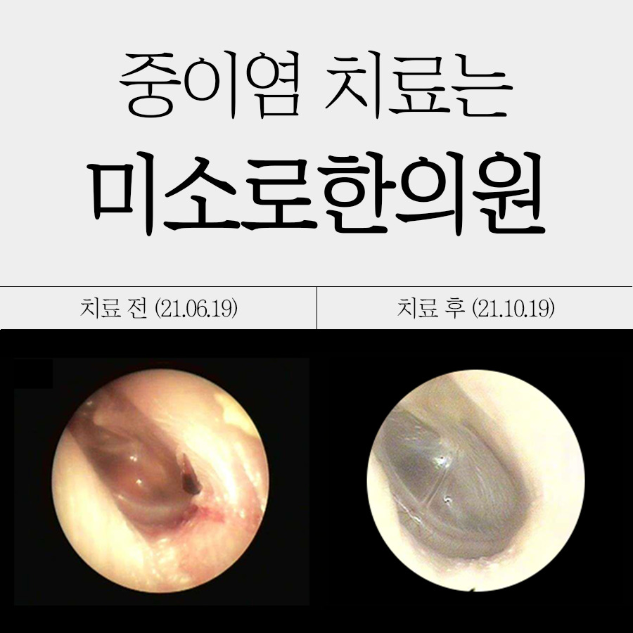 분당 만성중이염 수술 관련 이미지