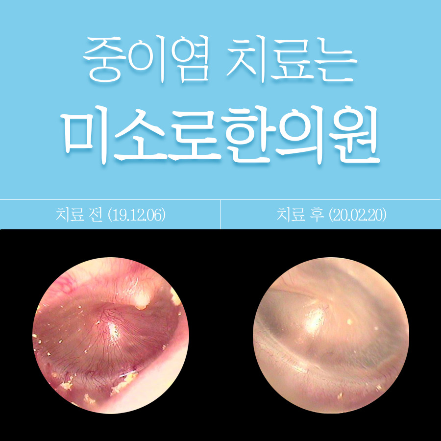 분당 삼출성 중이염 완치 관련 이미지
