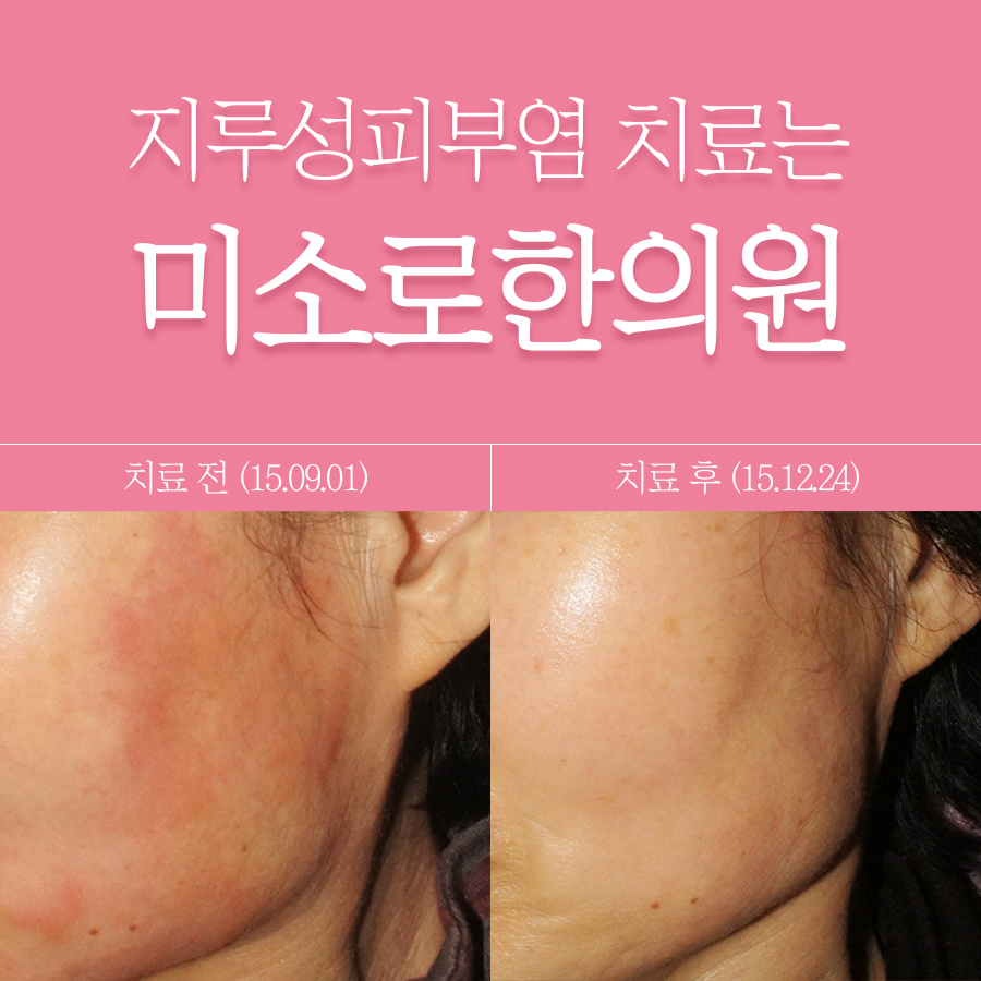 분당 지루성피부염 한의원 관련 이미지