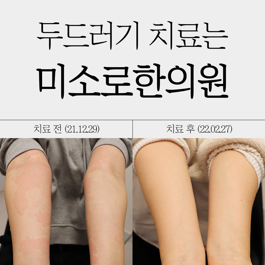 분당 만성두드러기 한의원 치료 관련 이미지