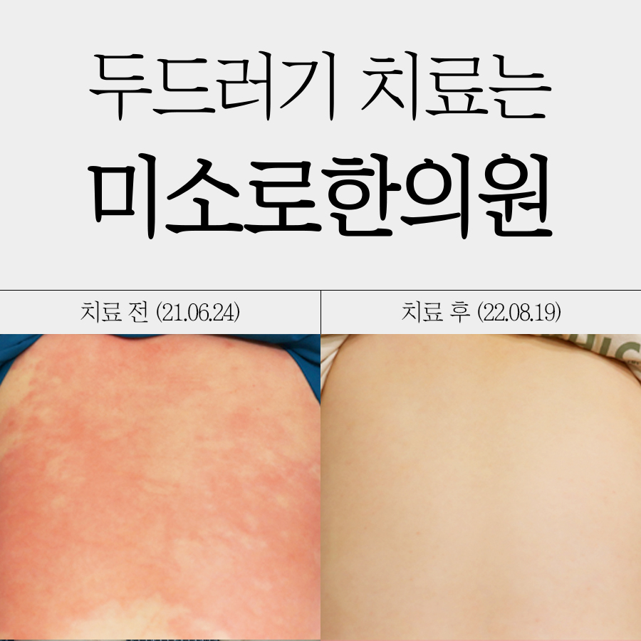분당 두드러기 한의원 관련 이미지