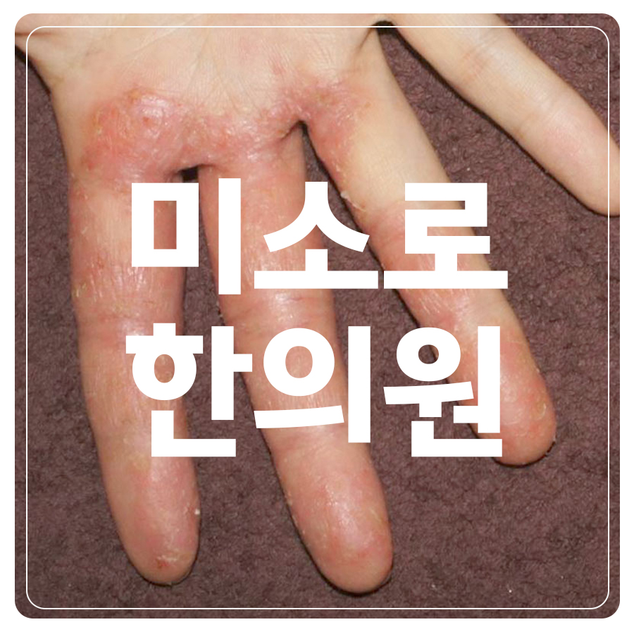 분당 발 한포진 연고 관련 이미지