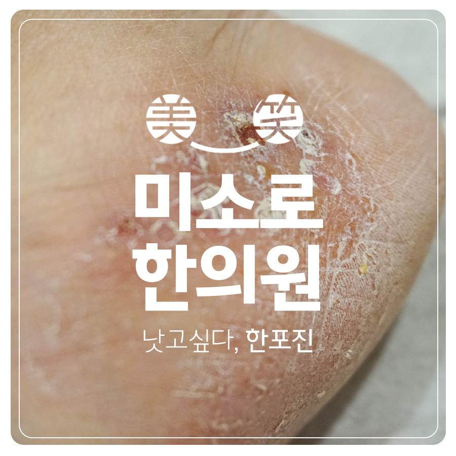 발 한포진 병원 관련 이미지