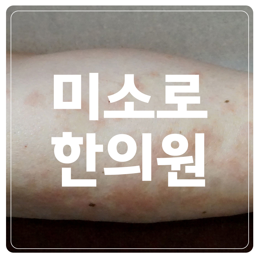 여주 피부묘기증 원인 관련 이미지