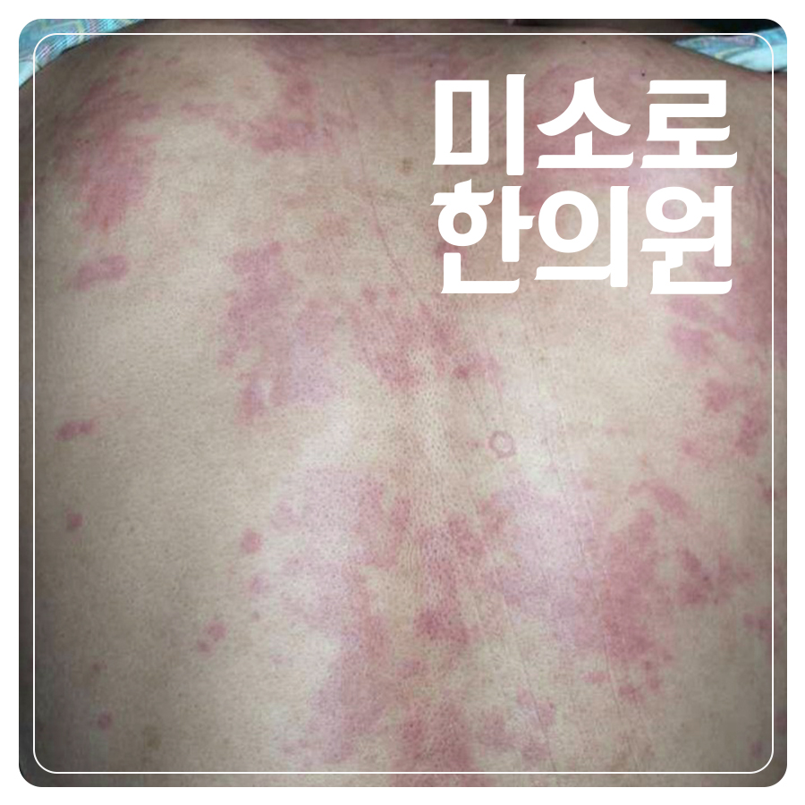 위례 피부묘기증 한의원 관련 이미지