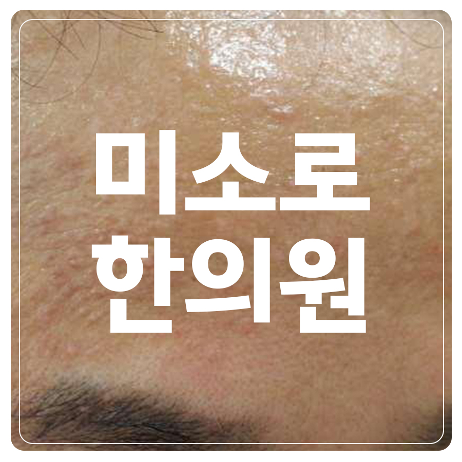 이천 발바닥 사마귀 수술 후기 관련 이미지