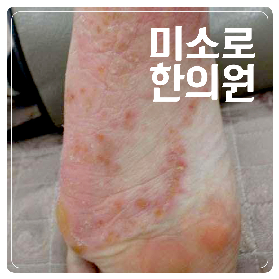 이천 발바닥 한포진 연고 추천 관련 이미지