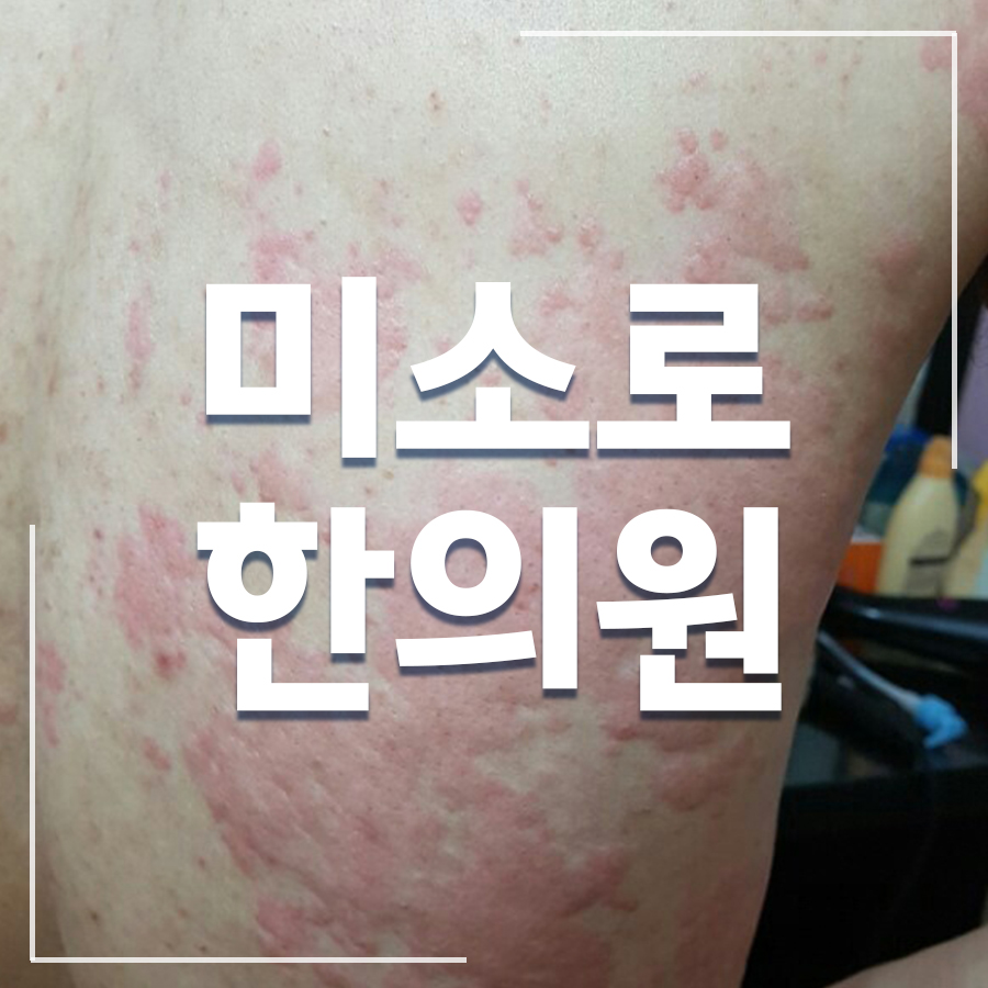 여주 두드러기 피부과 병원 관련 이미지