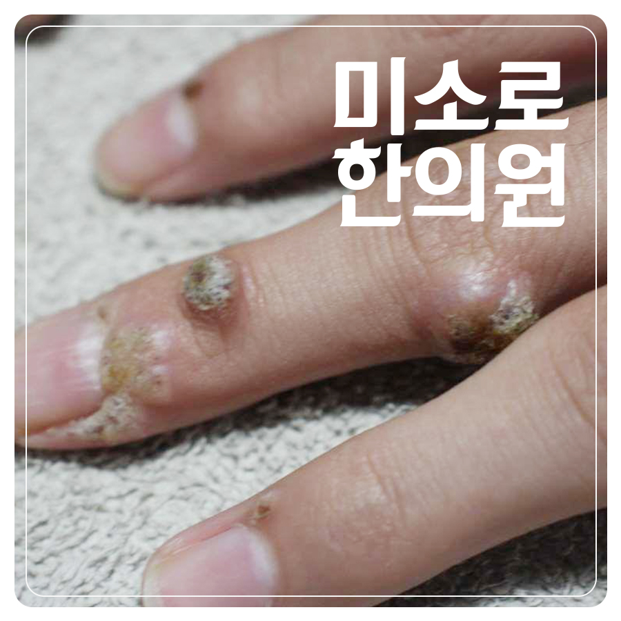 분당 편평사마귀 병원 성지 관련 이미지