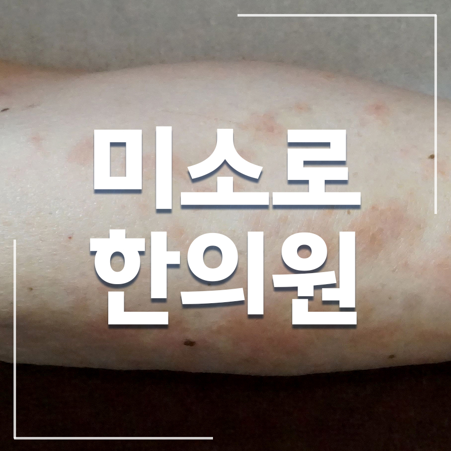 이천 두드러기 치료 잘하는 병원 관련 이미지