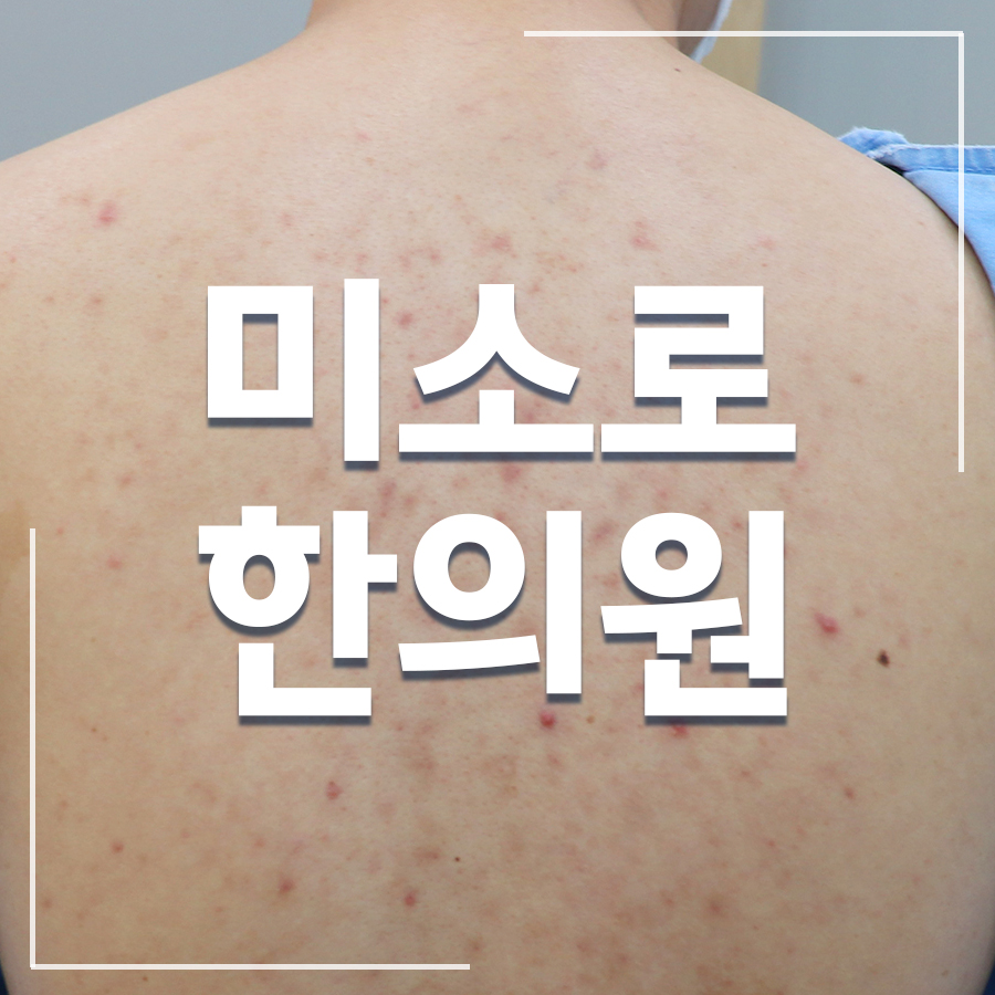 본오동 콜린성 두드러기 치료법 관련 이미지