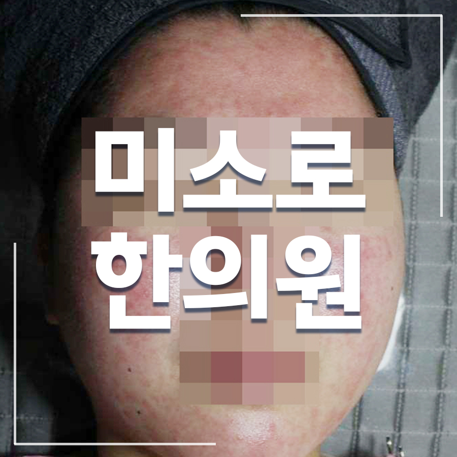 서신동 지루성피부염 병원 추천 관련 이미지