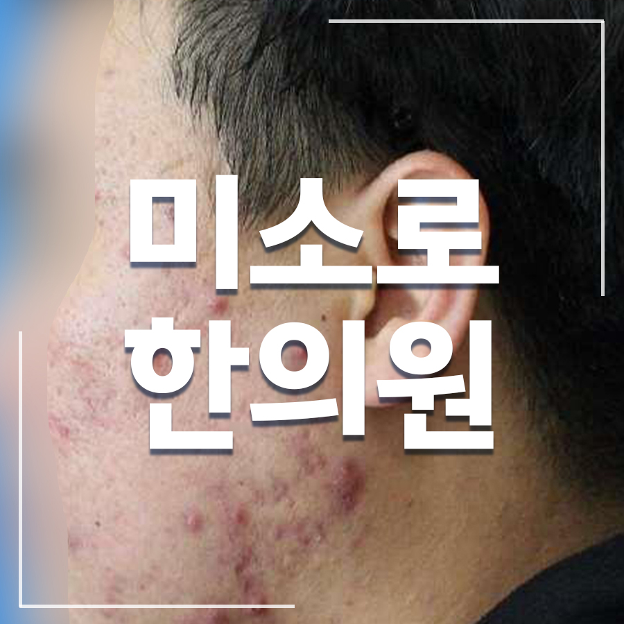 얼굴 지루성 피부염 치료 관련 이미지