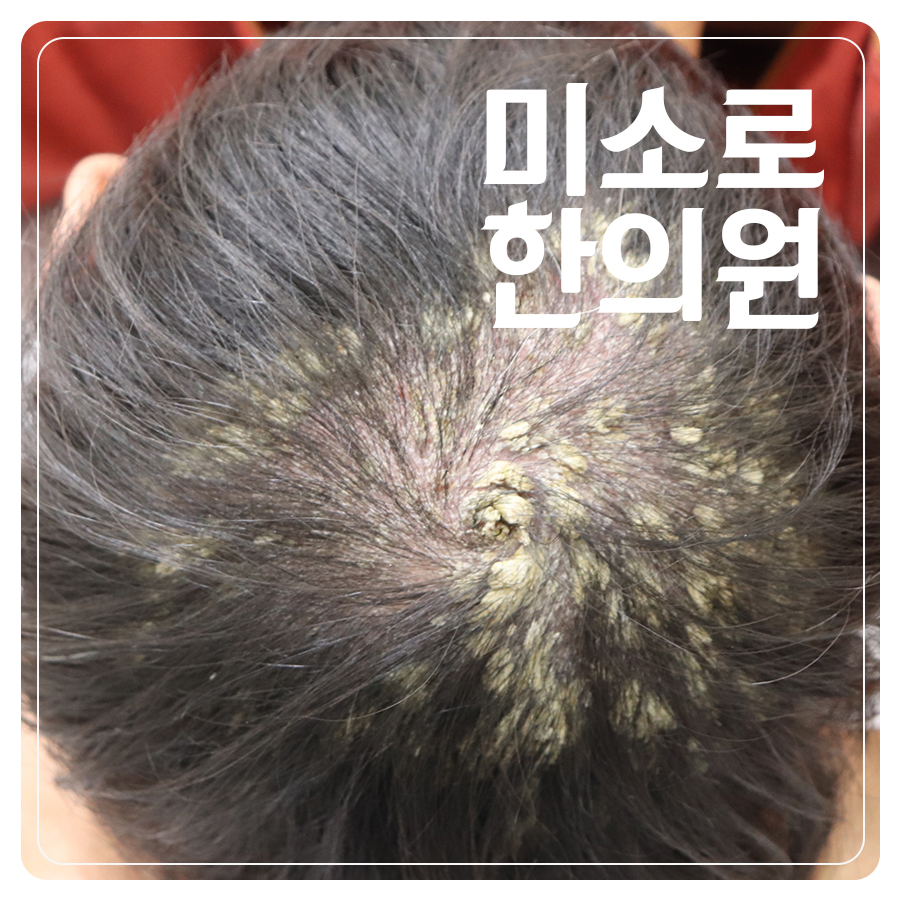 용인 건선 보습제 추천 관련 이미지