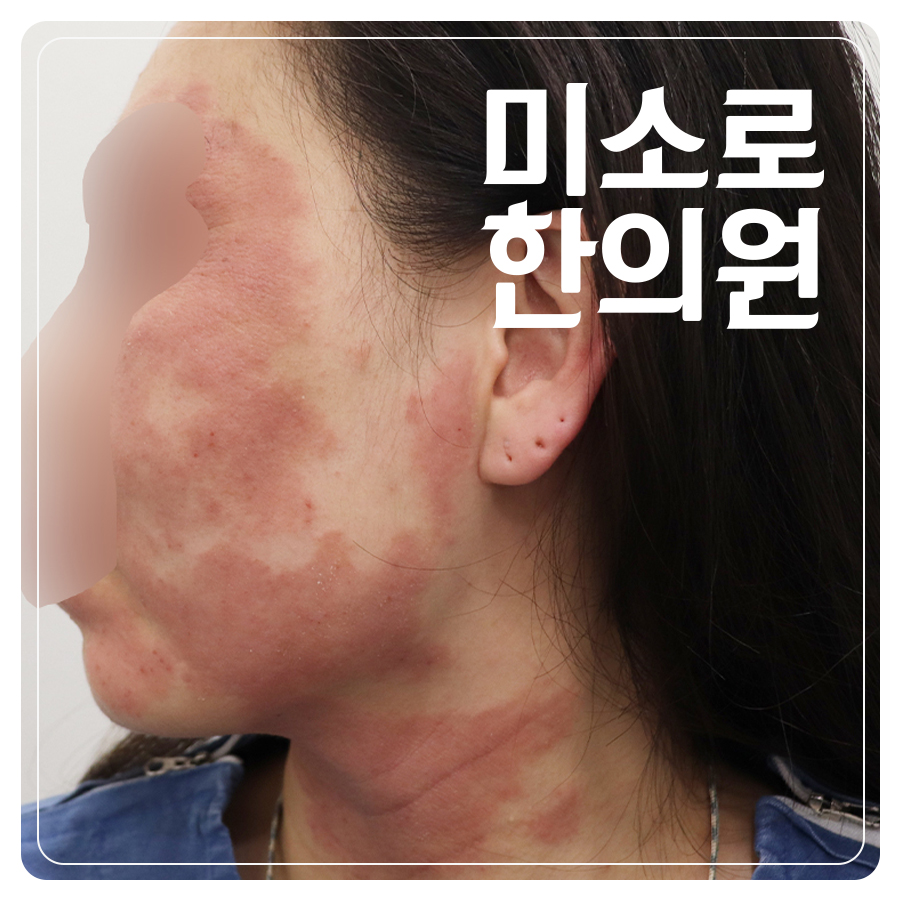 위례 소아 아토피 치료 병원 관련 이미지
