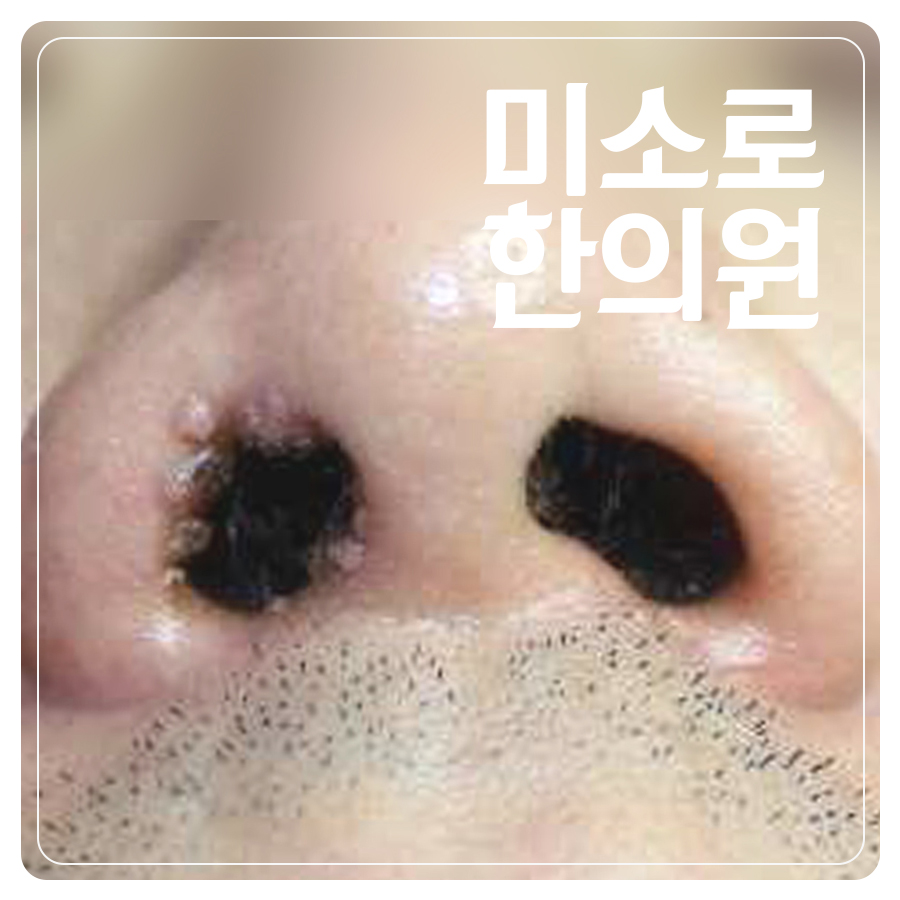분당 눈 편평사마귀 제거 관련 이미지