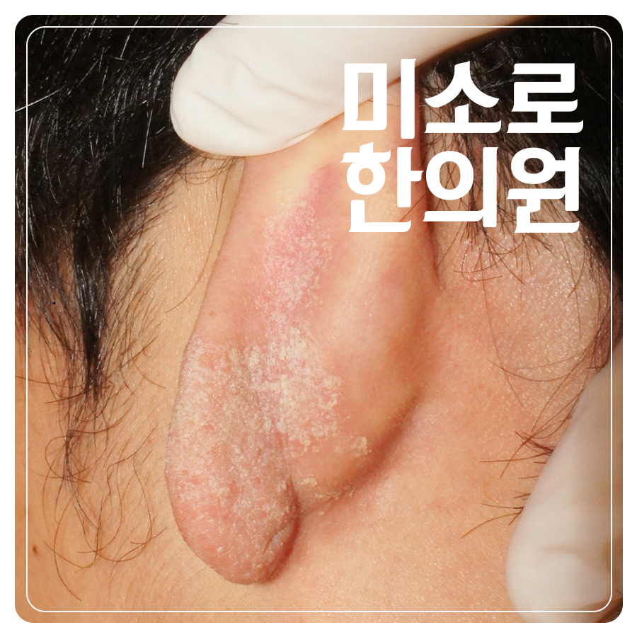 분당 농포성 건선 관리 관련 이미지
