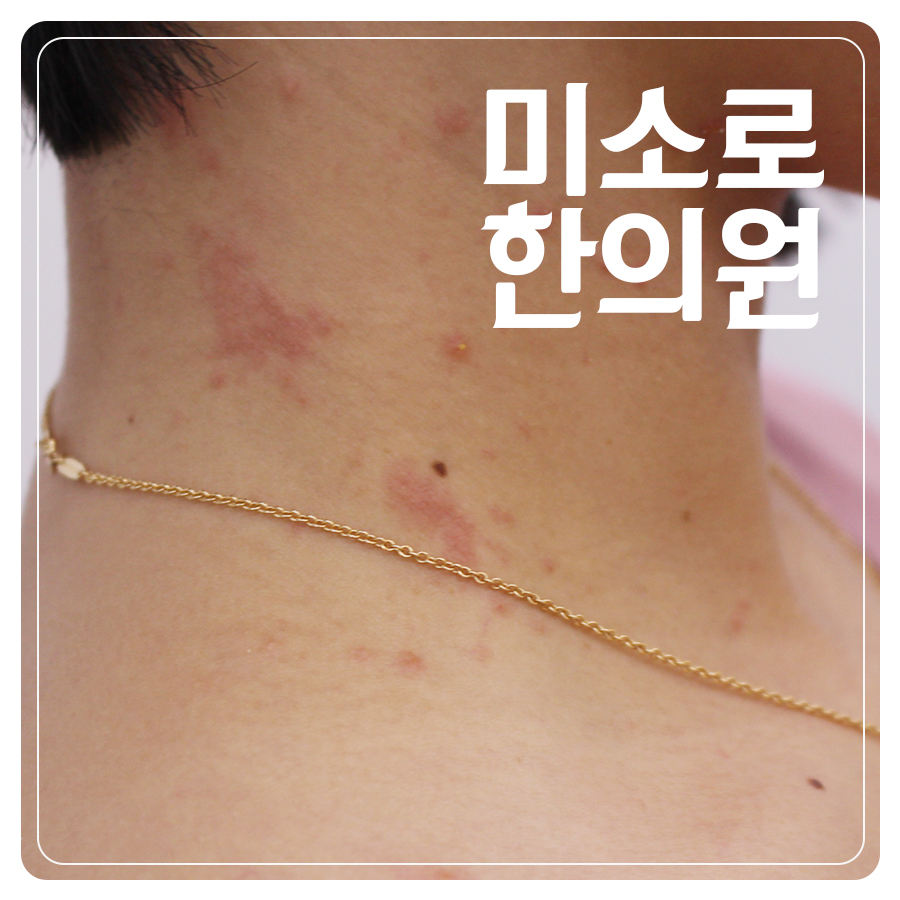 월피동 사타구니 습진 병원 어디로 관련 이미지