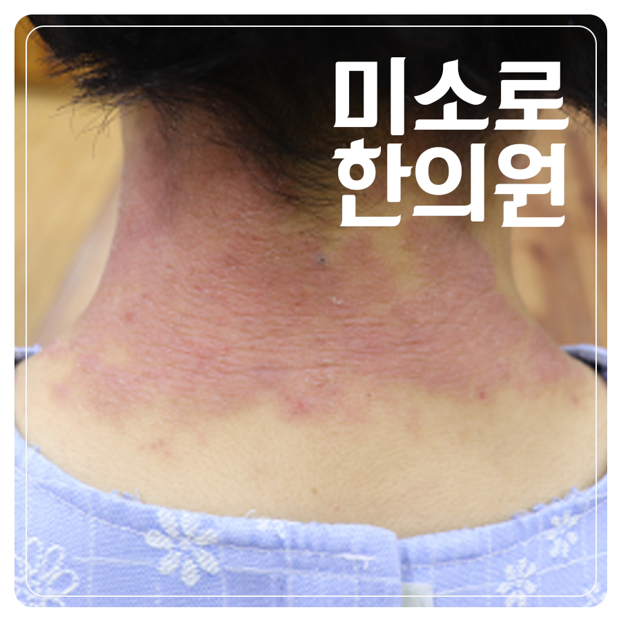 분당 아토피 한방치료 효과 관련 이미지