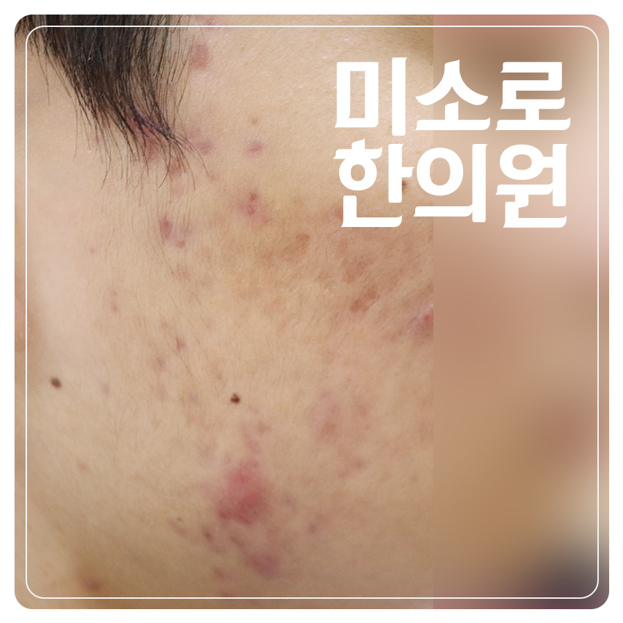 판교 화폐상습진치료 과정 관련 이미지