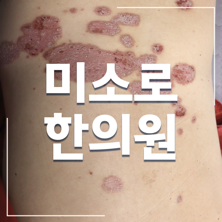 판교 건선치료법 관련 이미지