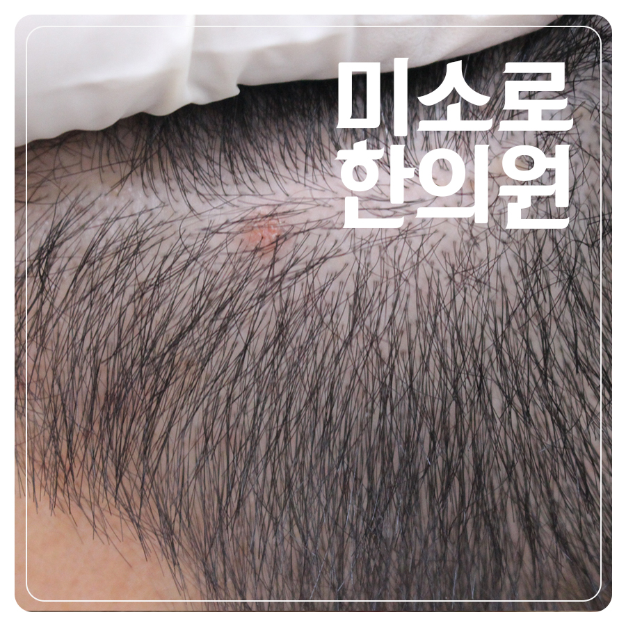 편평사마귀 한약 비용 관련 이미지