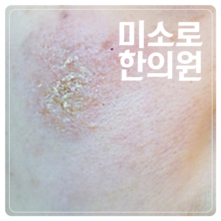 분당 건성 습진 증상 관련 이미지