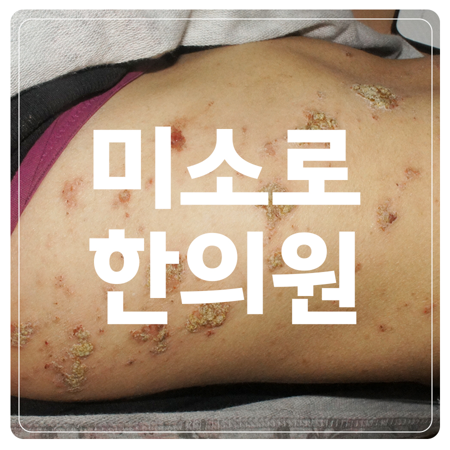 분당 화폐상 습진 치료 방법 관련 이미지