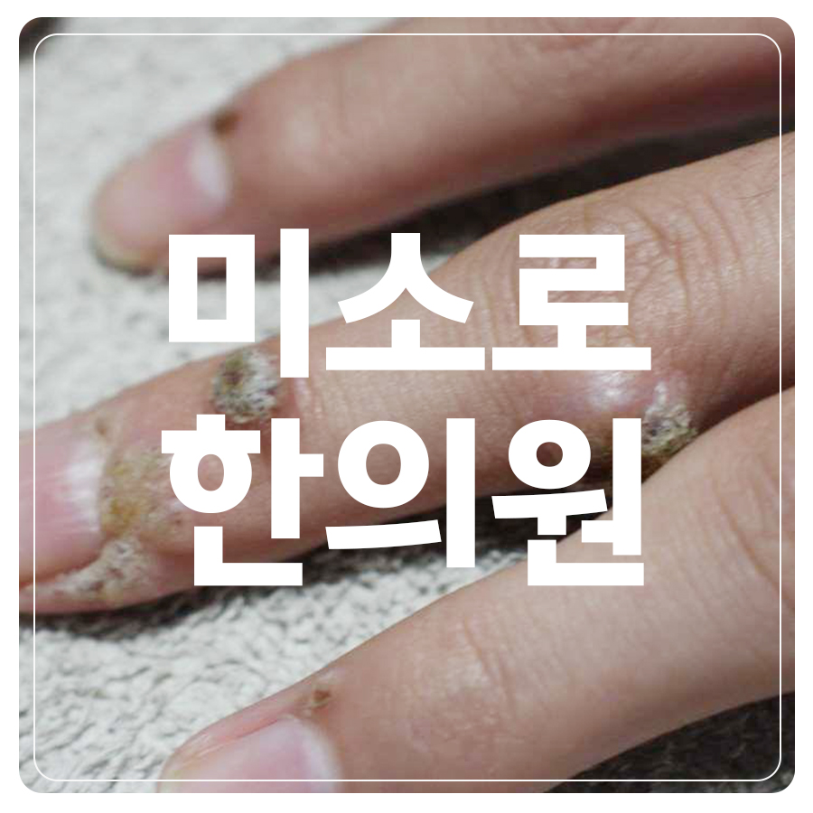 안산 한의원 사마귀치료 관련 이미지