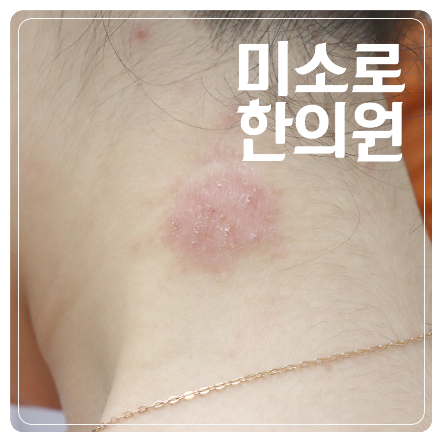 분당 아토피 피부염 증상 관련 이미지