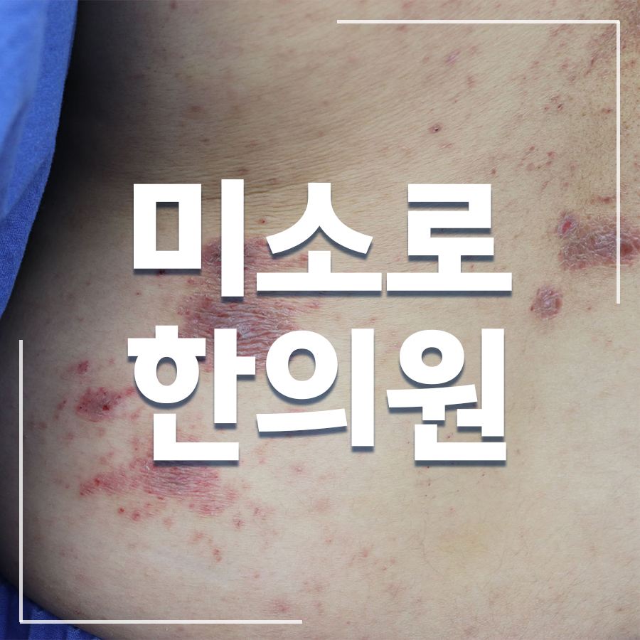 성남 사타구니 습진 연고 관련 이미지