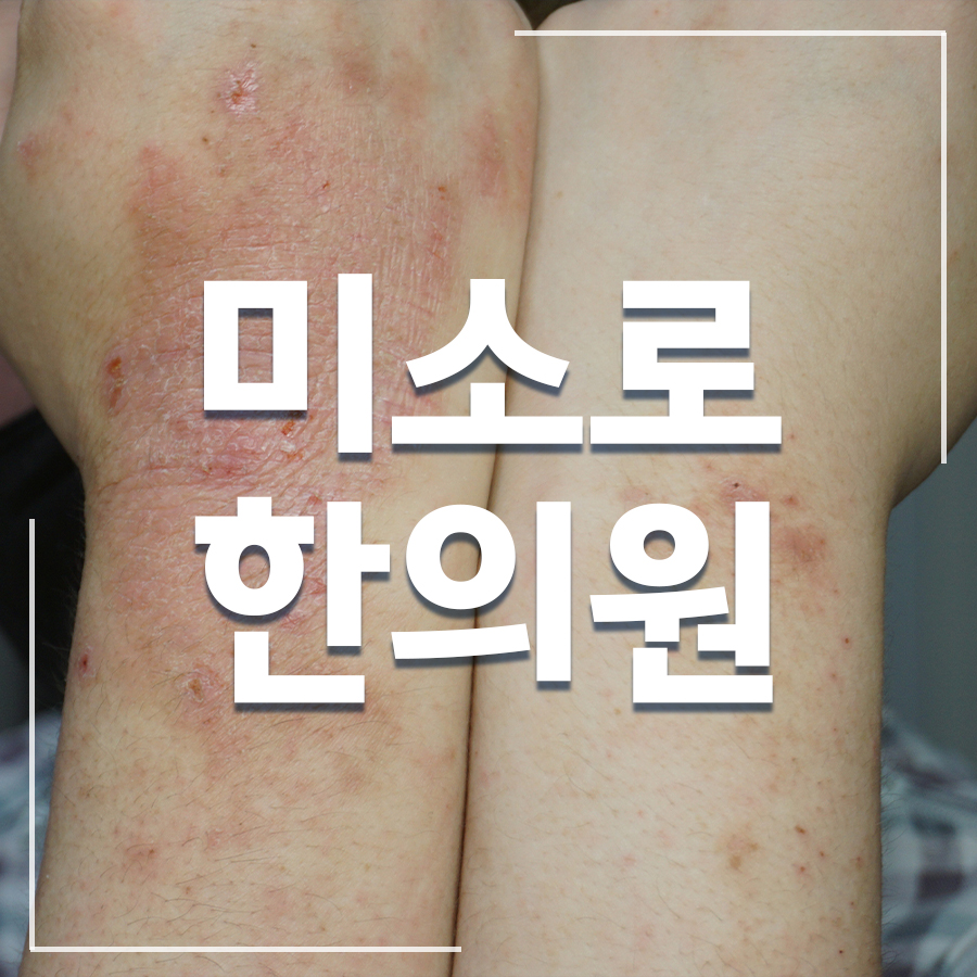안산 아토피에 좋은 약초 관련 이미지