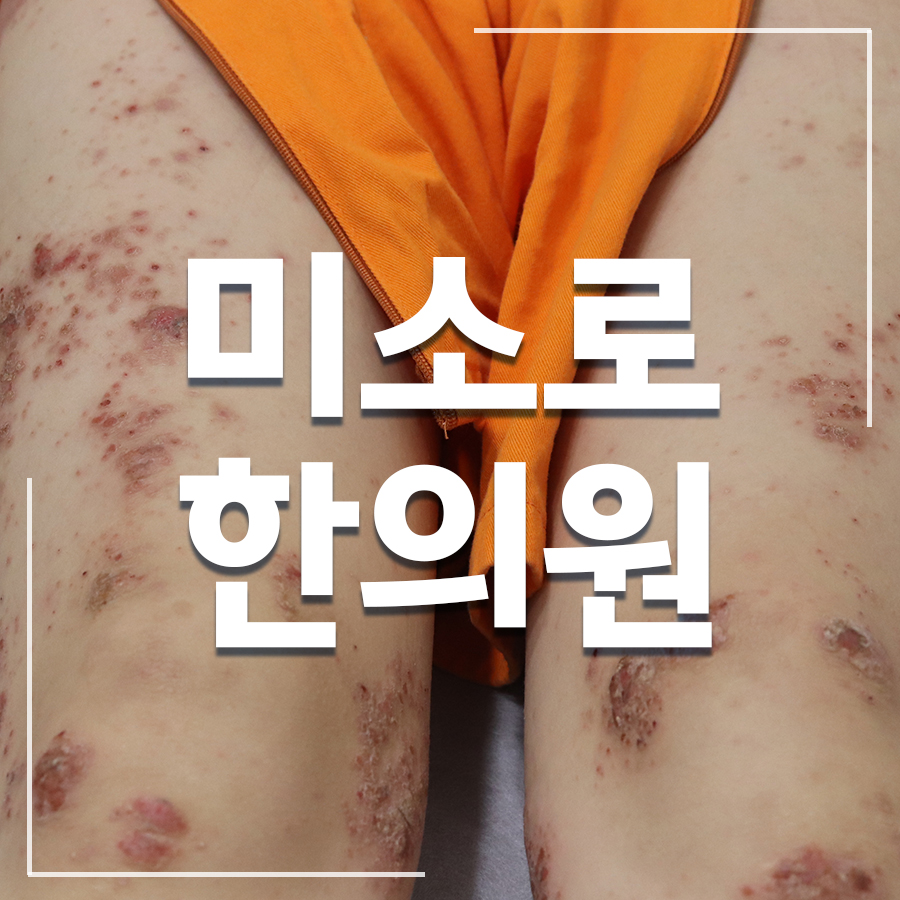 정자역 습진 가려움 이유 관련 이미지