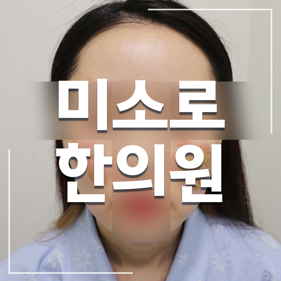 중동 화폐상 습진 치료 방법 관련 이미지