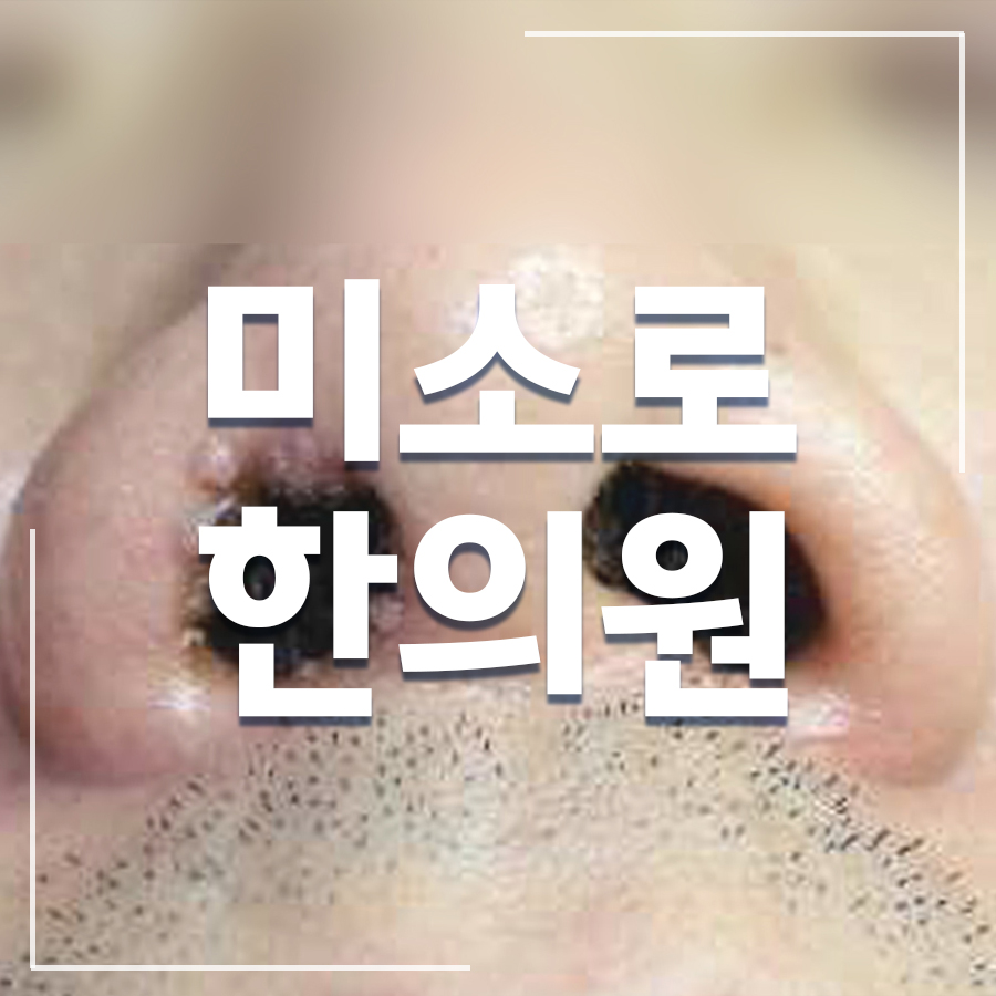 성남 편평사마귀제거레이저 관련 이미지