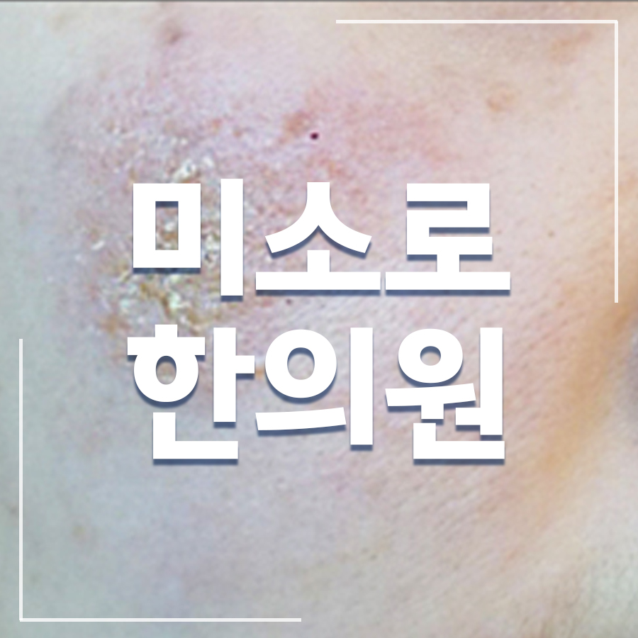 분당 습진 보습제 추천 관련 이미지