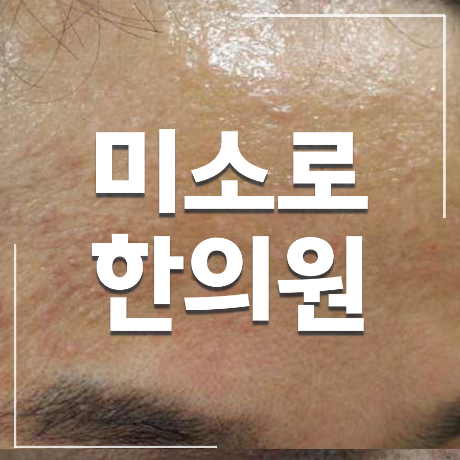 위례 바르는 평편사마귀 연고 관련 이미지