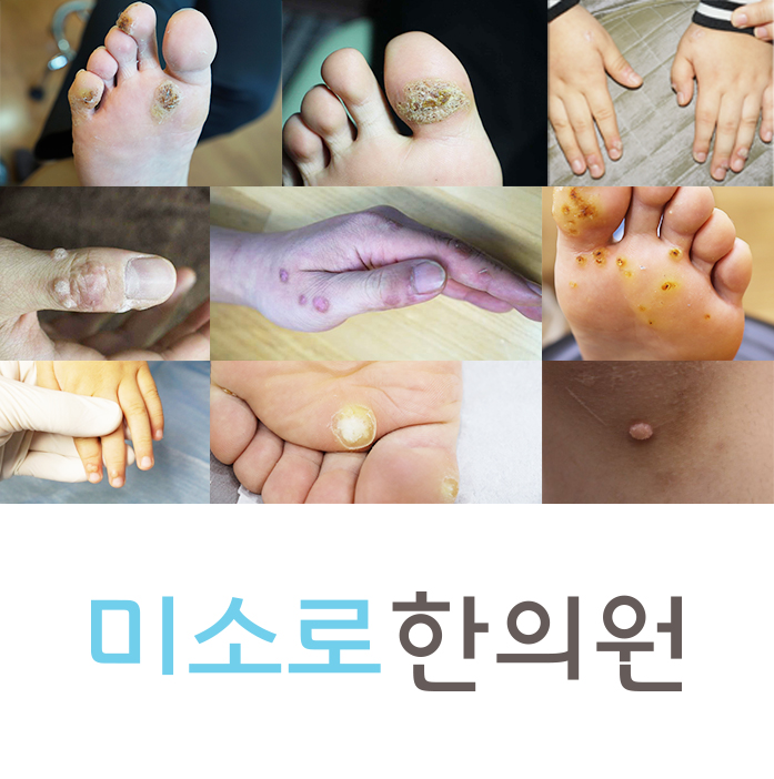 성남 사마귀면역치료 후기 관련 이미지