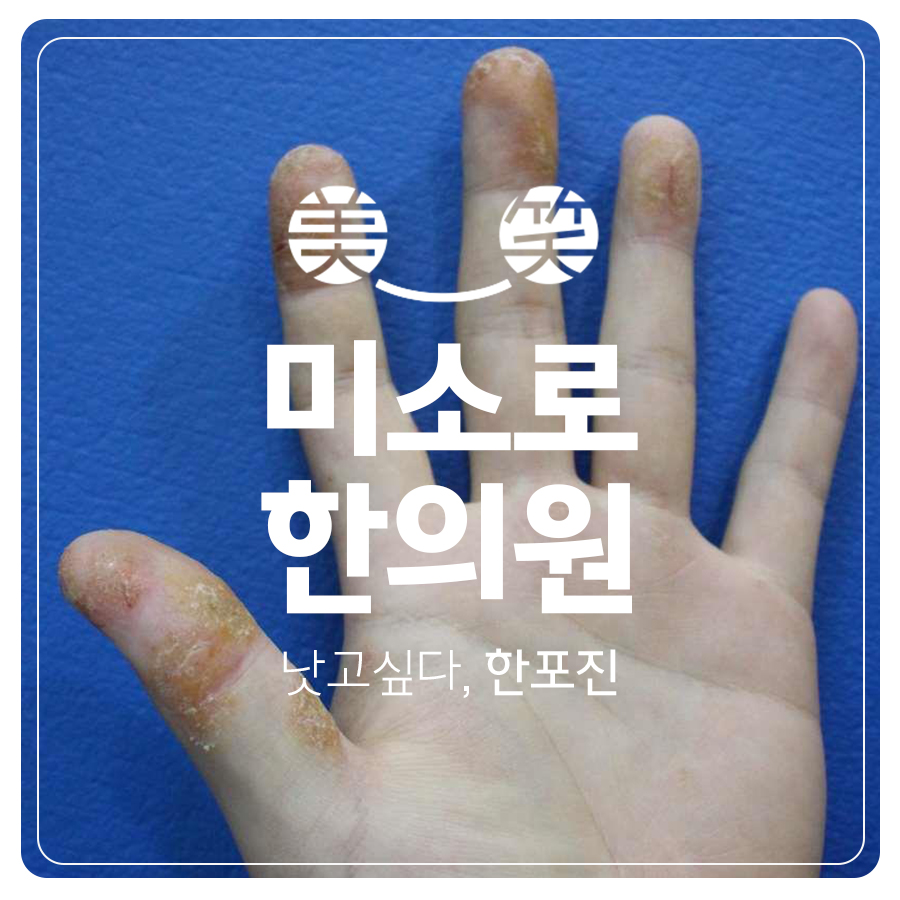 분당 발 한포진 연고 관련 이미지
