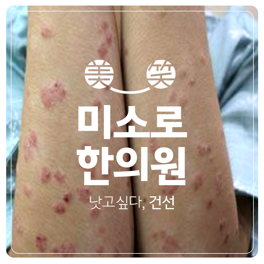 분당 건선 보습제 추천 관련 이미지