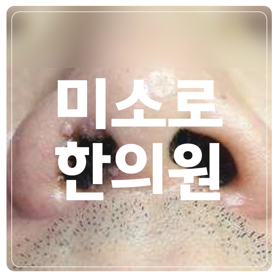 분당 손등 편평사마귀 살리실산 관련 이미지