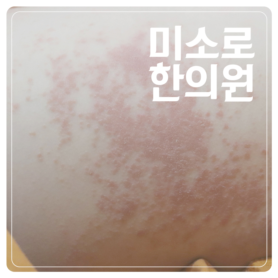 경기광주 지루성피부염 병원 추천 관련 이미지