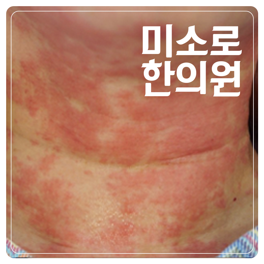 피부묘기증 관련 이미지