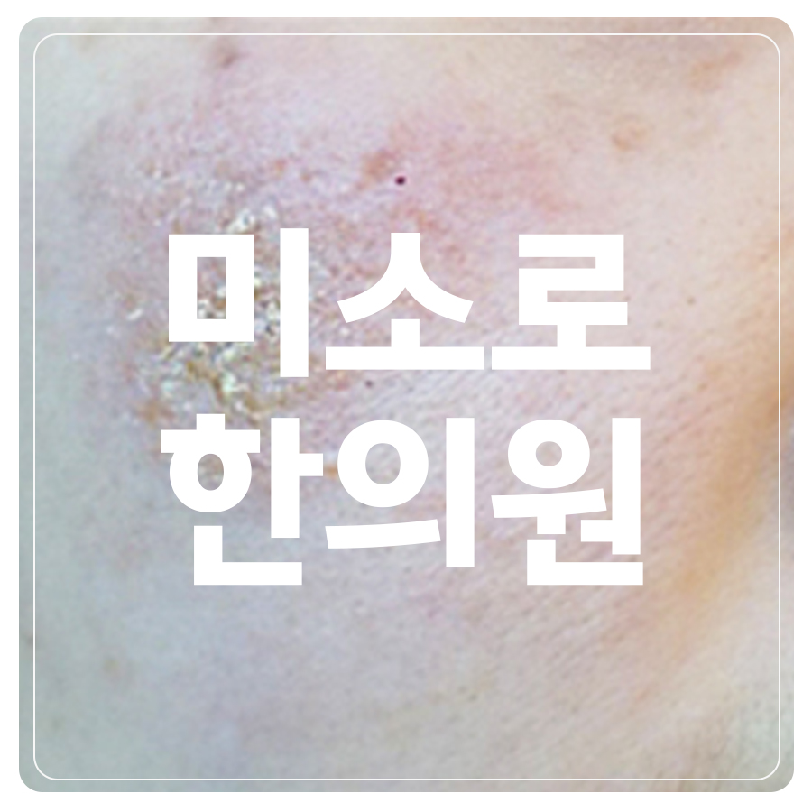 매탄동 화폐상 습진 원인 관련 이미지
