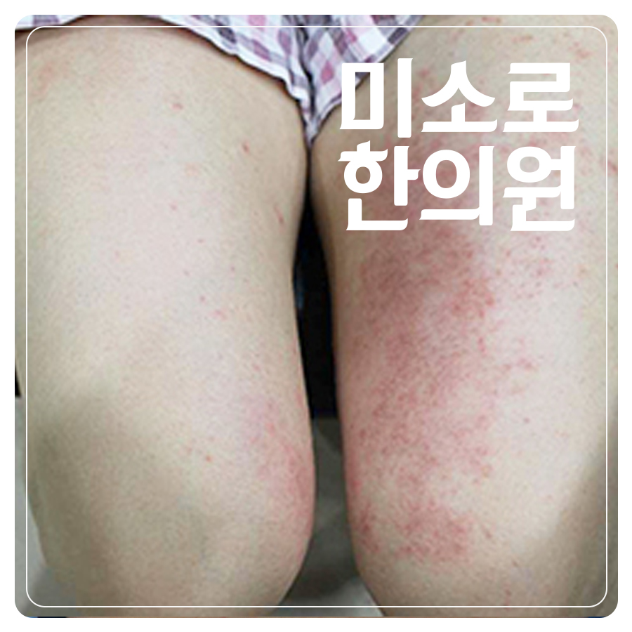 성남 피부가려움두드러기 병원 관련 이미지